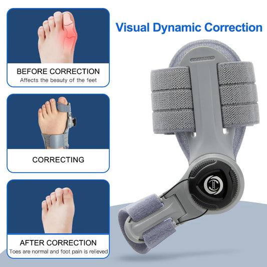 Orthopedic Bunion Corrector